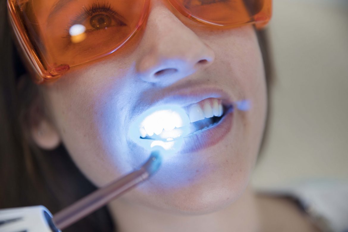 blanqueamiento-dental-en-Lima-gafas-protectoras-1170x780